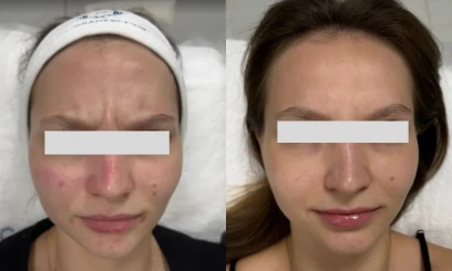 Ботулинотерапия 2